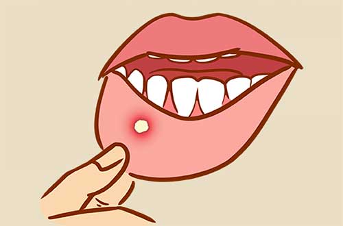 口腔溃疡是什么原因引起的，8个原因导致口腔溃疡