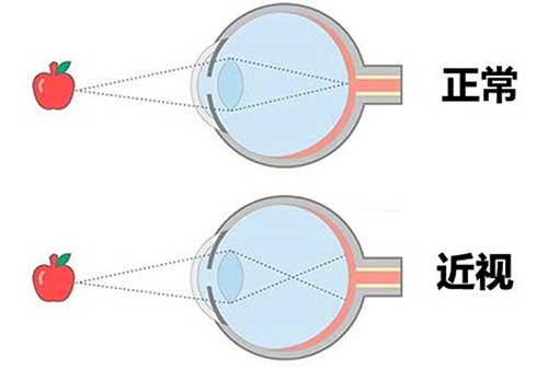 近视眼如何恢复视力，7个近视眼慢慢恢复视力的方法
